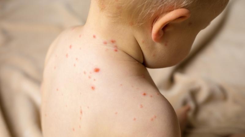 Trẻ bị sốt phát ban cần kiêng gì? Những điều quan trọng khi điều trị sốt phát ban cho bé.