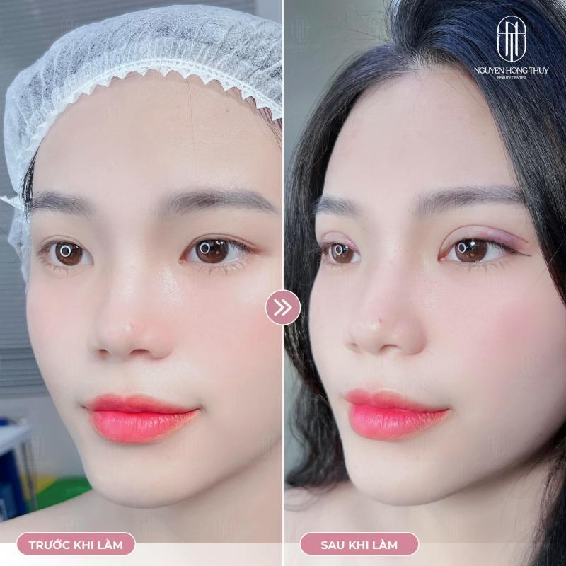 Top 7 Địa Chỉ Cắt Mí Đẹp Và An Toàn Nhất Tại Gia Lai