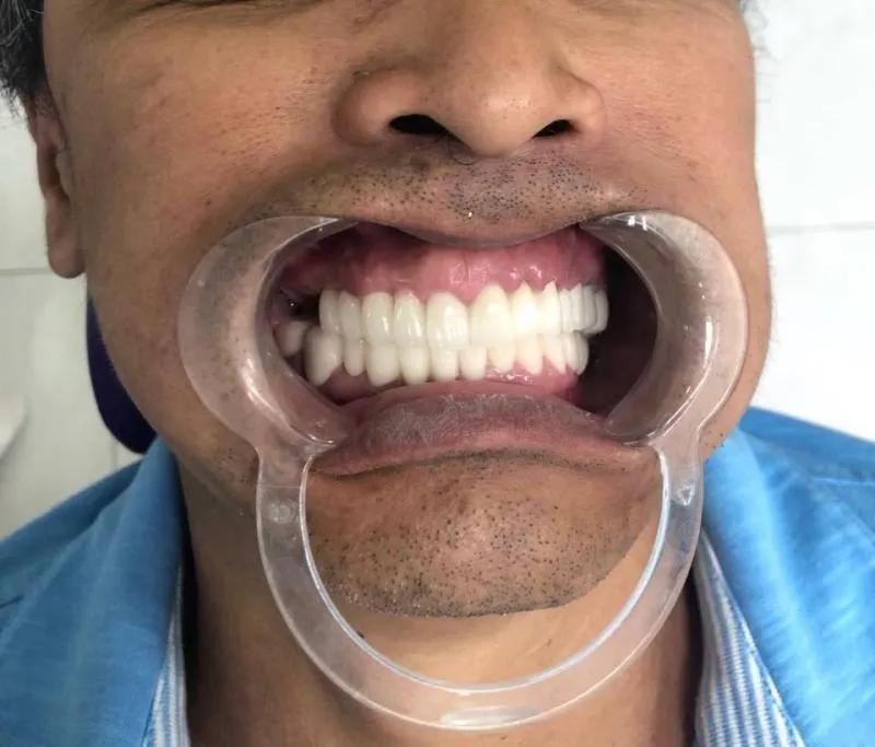 Khám phá 9 địa chỉ bọc răng sứ uy tín hàng đầu tại Hà Tĩnh