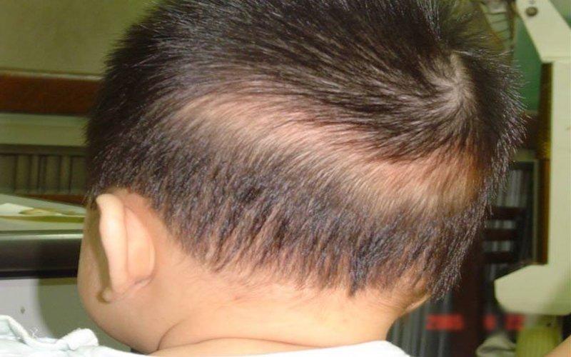Nguyên nhân, dấu hiệu và phương pháp điều trị rụng tóc vành khăn ở trẻ nhỏ