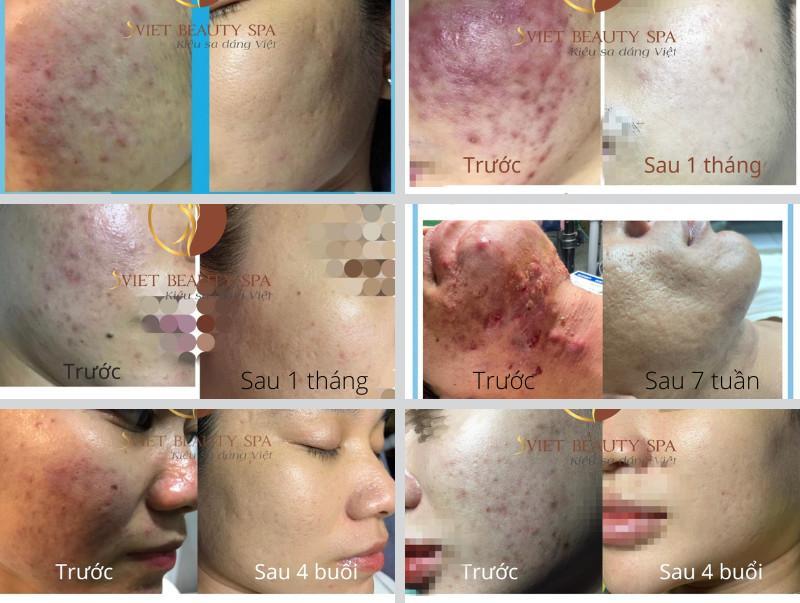 Top 9 Địa chỉ trị mụn hiệu quả, được tin chọn nhất tại Hà Nội