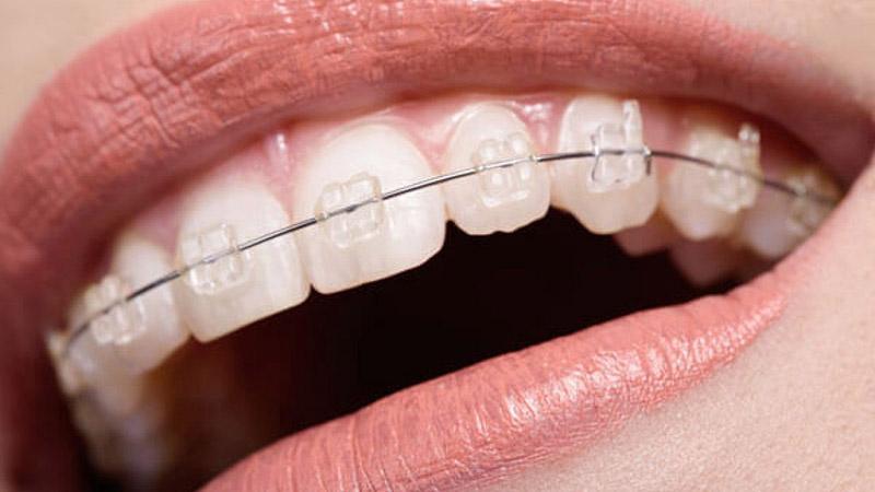 6 Điều Quan Trọng Cần Biết Về Niềng Răng Mắc Cài Sứ Dây Trong