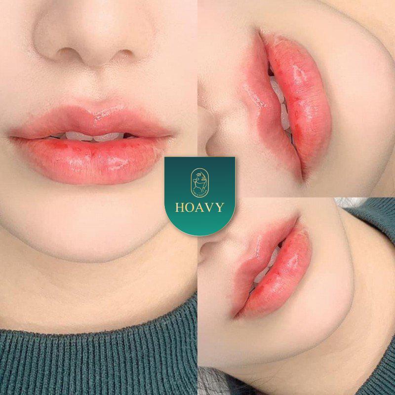 Top 7 địa chỉ tiêm filler và botox uy tín nhất Hải Phòng
