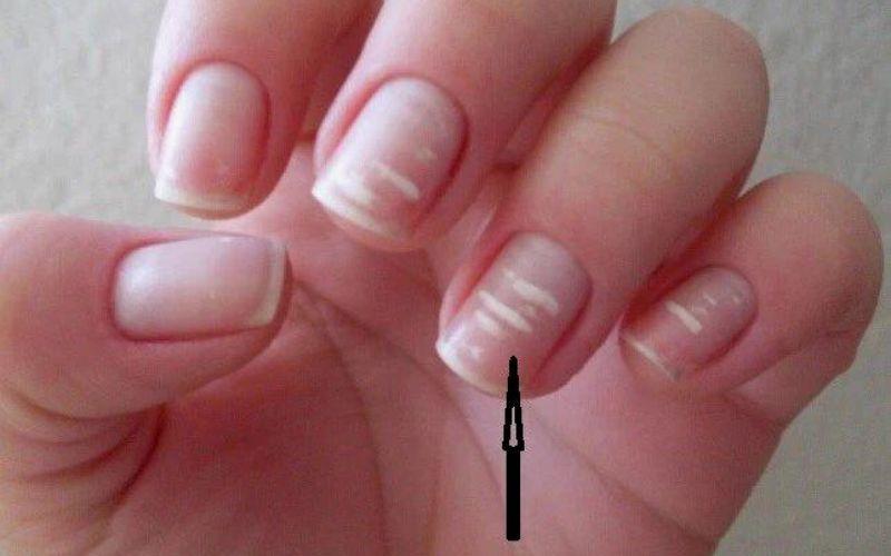 Móng tay có đốm trắng là gì? Giải mã những hạt gạo bí ẩn trên móng tay