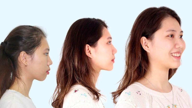Niềng răng có thật sự làm thay đổi diện mạo góc nghiêng không?