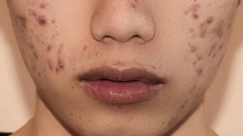 Top 10 serum trị thâm mụn hiệu quả nhất đang được ưa chuộng hiện nay