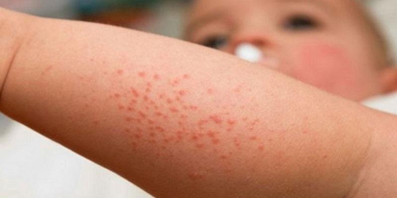 Khi nhiệt độ tăng cao, người lớn và trẻ nhỏ phải làm gì để bảo vệ sức khỏe và tránh khỏi những căn bệnh nguy hiểm trong mùa hè?