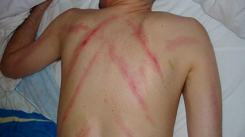 Cạo gió là một phương pháp truyền thống được nhiều người áp dụng để giúp cải thiện sức khỏe. Tìm hiểu về phương pháp này và những tác dụng cũng như cách thực hiện đúng để đạt hiệu quả tốt nhất.
