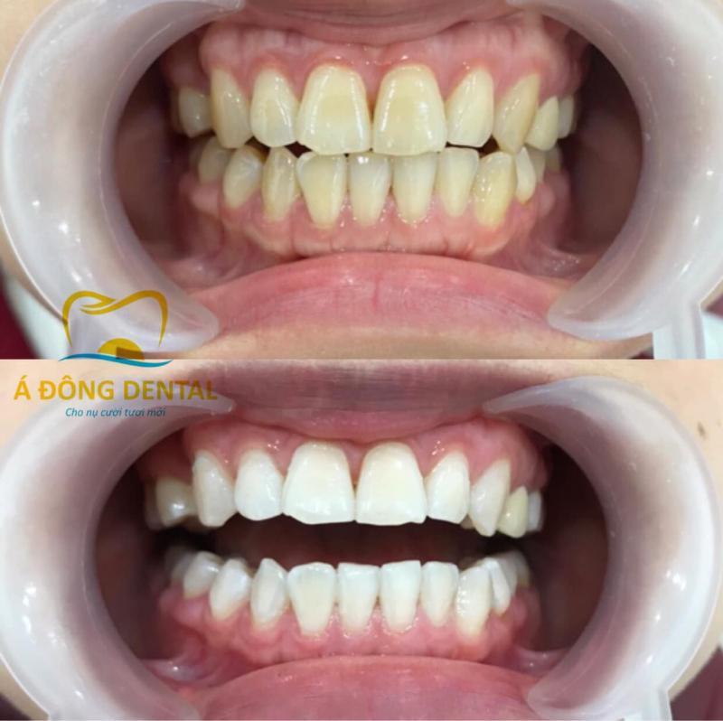 Top 10 địa chỉ tẩy trắng răng uy tín hàng đầu tại TP. Buôn Ma Thuột, Đắk Lắk