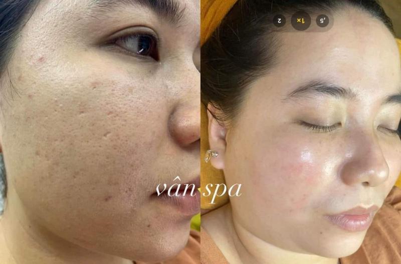 Top 10 địa chỉ trị thâm uy tín tại Thừa Thiên Huế
