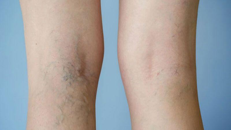 Những tư thế ngủ tối ưu cho người mắc suy giãn tĩnh mạch