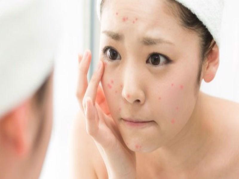 Phương pháp trị mụn trứng cá tại nhà với nguyên liệu từ thiên nhiên