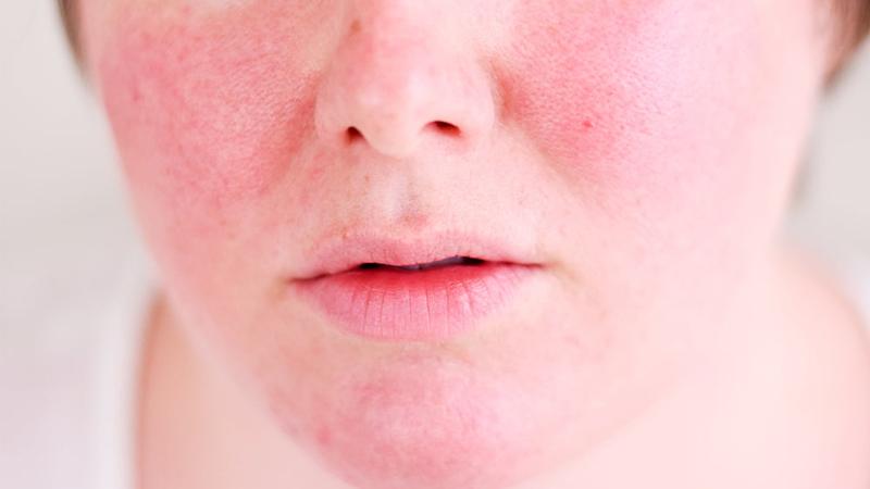 Retinol đẩy mụn kéo dài bao lâu? Nên làm gì khi da đang trong giai đoạn đẩy mụn?