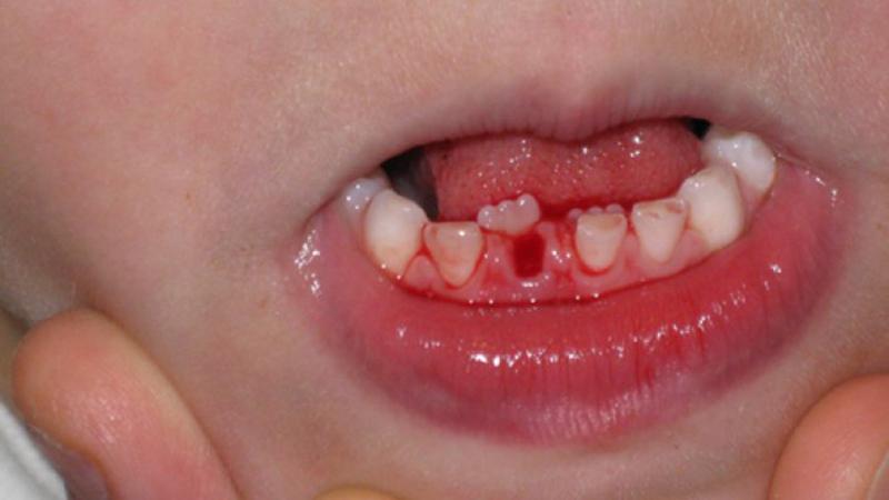 Trong số 10 trẻ em, có đến 5 em phải đối mặt với tình trạng hàm răng đôi, nguyên nhân chủ yếu bắt nguồn từ thói quen nuông chiều con cái trong việc ăn uống của các bậc phụ huynh.