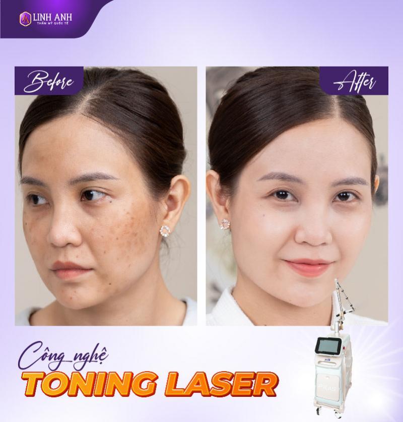 Top 9 Địa Chỉ Điều Trị Nám, Tàn Nhang Uy Tín Nhất Đà Nẵng