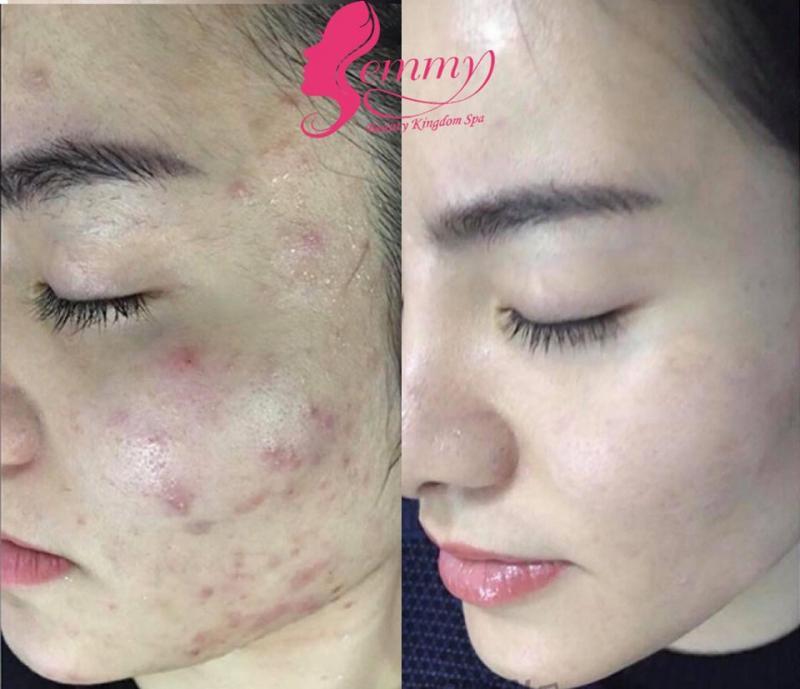 Top 7 Spa trị sẹo rỗ do mụn hiệu quả nhất tại Huế