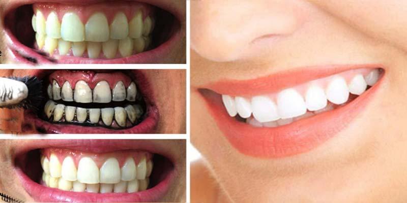 Top 17 phương pháp làm đẹp răng tự nhiên, trắng sáng hiệu quả tuyệt vời