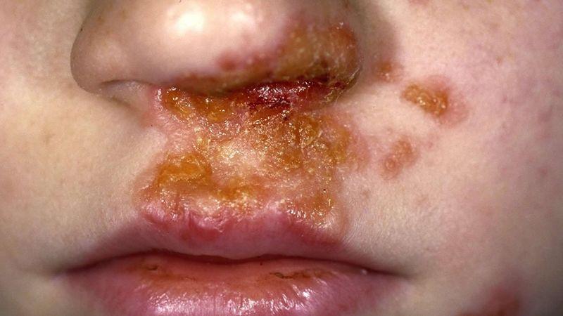 Cha mẹ cần làm gì khi con bị chốc? Hướng dẫn đầy đủ và thiết thực