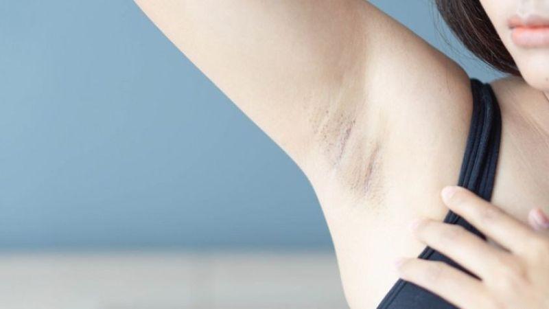 Vì sao bà bầu lại gặp phải tình trạng thâm nách? Cách thức khắc phục tình trạng này trong suốt thai kỳ