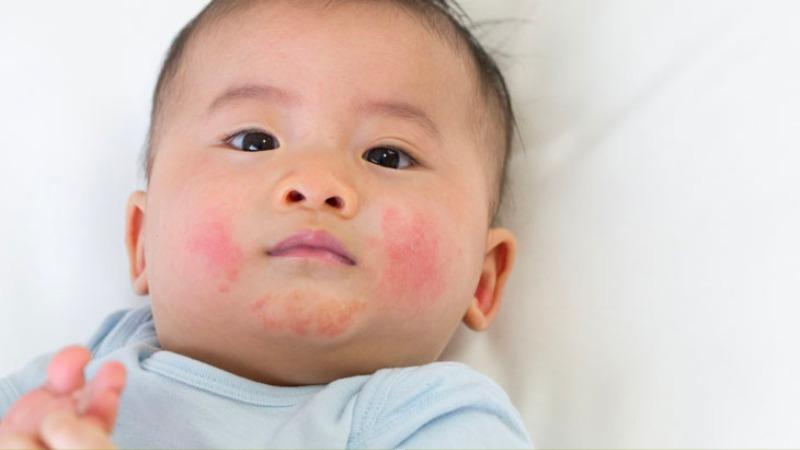 Vì sao trẻ bị nổi mẩn đỏ giống muỗi đốt và cách xử lý hiệu quả?