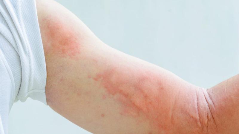 Uống thuốc tẩy giun quá liều có gây hại không? Cách xử lý nhanh chóng và hiệu quả.