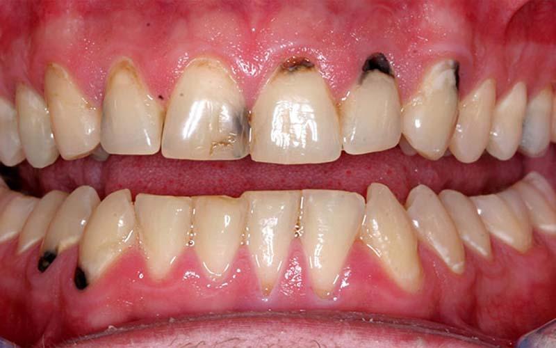 Nguyên nhân khiến viền chân răng bị đen và cách xử lý hiệu quả