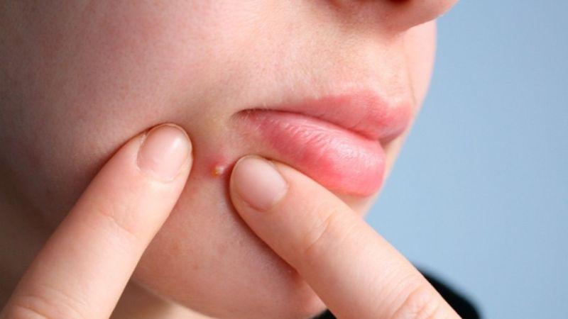 Tự nặn mụn nhọt tại nhà có phải là lựa chọn đúng đắn? Phương pháp xử lý mụn nhọt sao cho hiệu quả và an toàn?