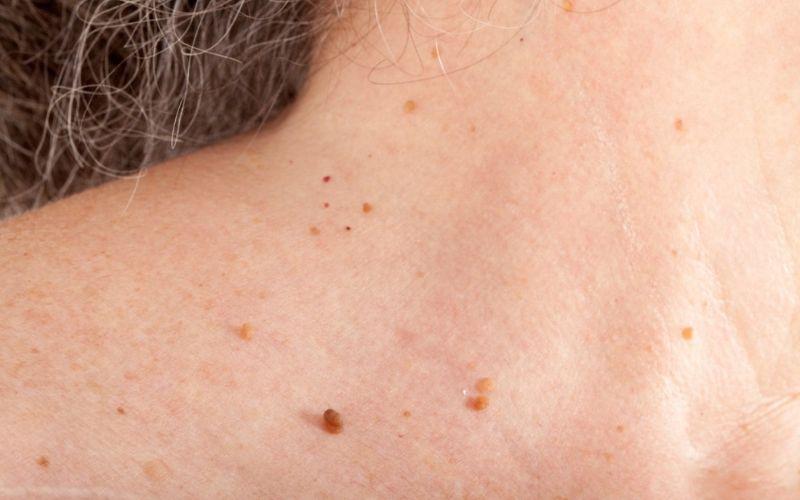 Khám phá 5 loại thuốc trị mụn thịt hiệu quả, giúp loại bỏ mụn nhanh chóng và an toàn.
