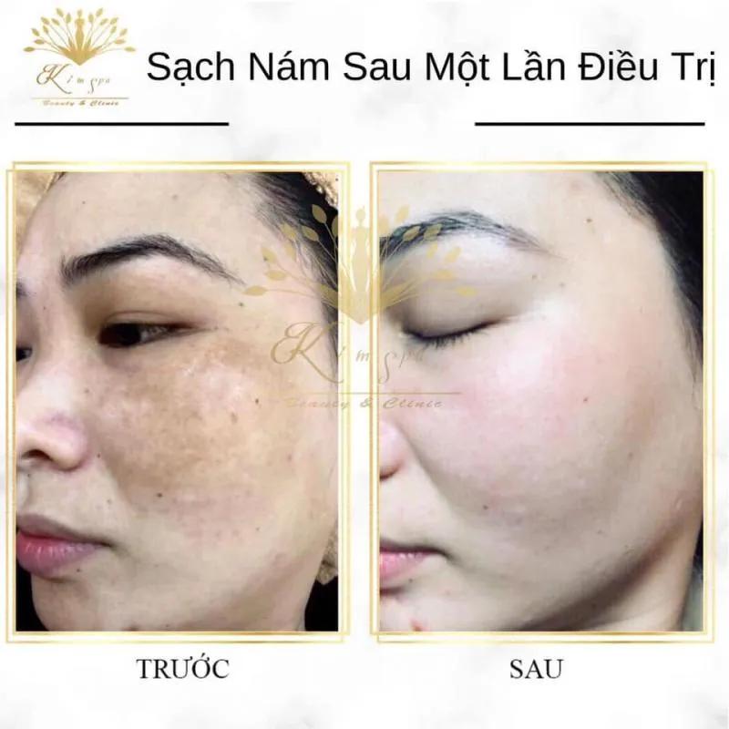 Top 10 địa chỉ điều trị nám hiệu quả nhất tại Pleiku, Gia Lai