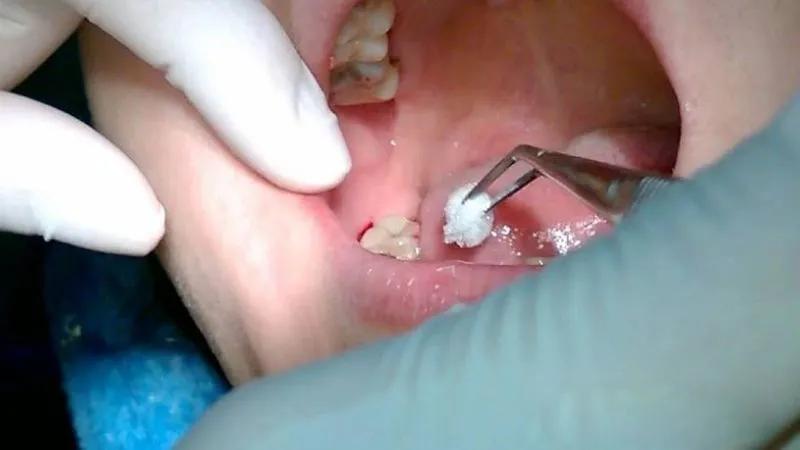 7 cách đơn giản và hiệu quả giúp cầm máu sau khi nhổ răng ngay tại nhà