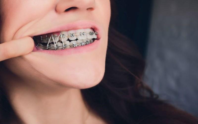 Thun liên hàm là gì? Vì sao nó lại đóng vai trò quan trọng trong quá trình niềng răng?