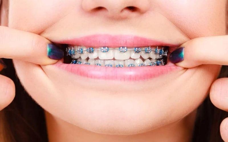 Niềng răng là gì? Khám phá lợi ích, chi phí và đối tượng phù hợp