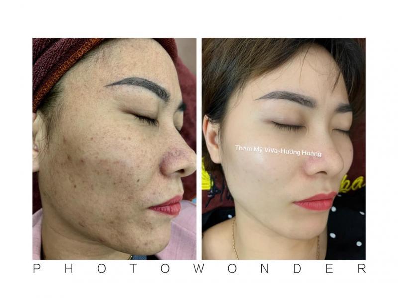Top 8 spa trị mụn hiệu quả tại Ninh Bình – Tripi