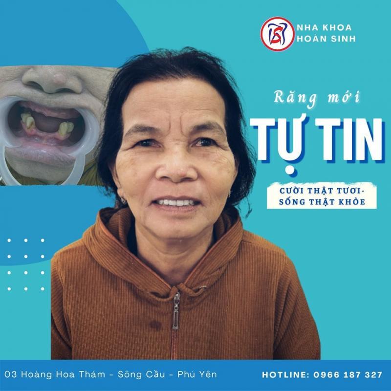 Top 8 địa chỉ bọc răng sứ uy tín nhất tại Phú Yên