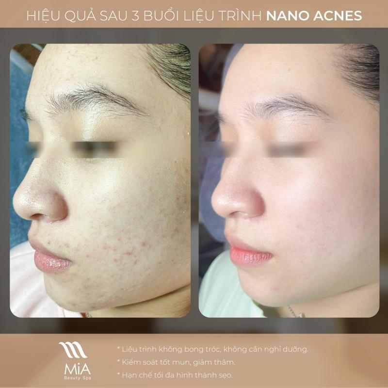 Top 9 địa chỉ trị mụn uy tín tại quận Bình Thạnh, TP. HCM