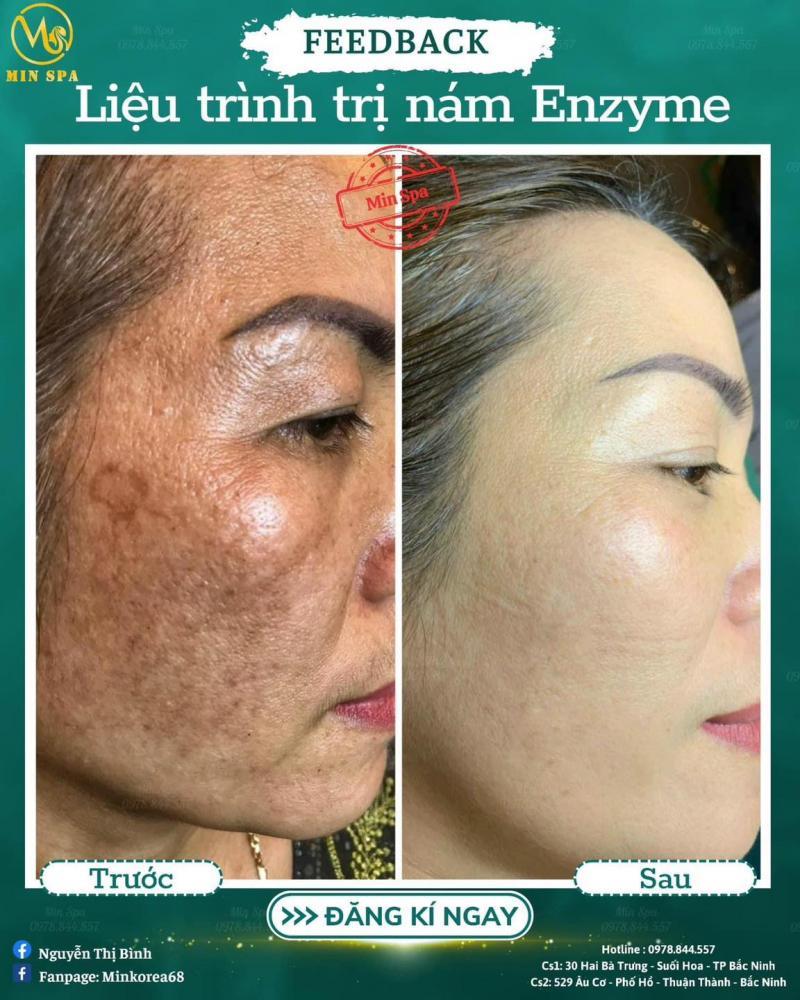 Top 11 Spa trị nám hàng đầu tại tỉnh Bắc Ninh