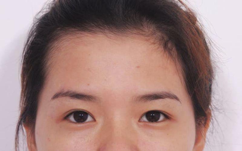 Mắt mí lót là gì? Và làm thế nào để cải thiện đôi mắt này? Hãy cùng khám phá các phương pháp khắc phục hiệu quả.