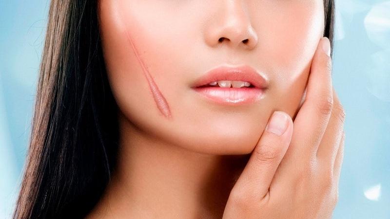 Cách xóa sẹo lồi nhanh chóng ngay tại nhà chỉ với nguyên liệu từ thiên nhiên