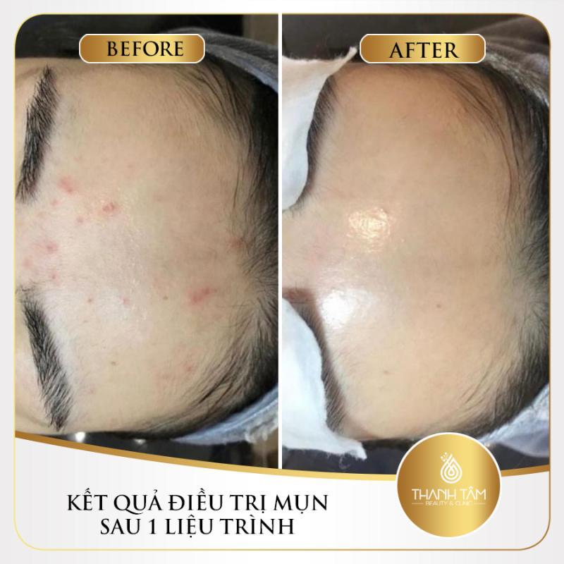 Top 4 spa trị mụn uy tín tại quận 9, TP. HCM