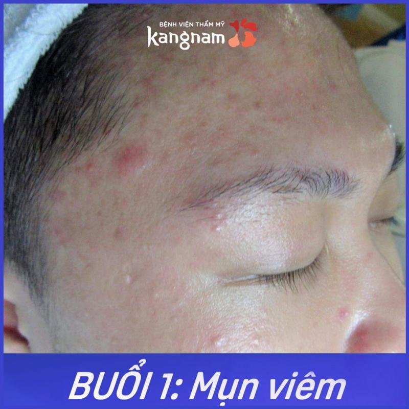 Top 10 địa chỉ điều trị mụn và nặn mụn uy tín tại TP HCM