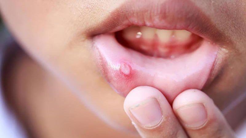 Nhiệt miệng nên làm gì? 9 cách nhanh chóng đẩy lùi nhiệt miệng hiệu quả