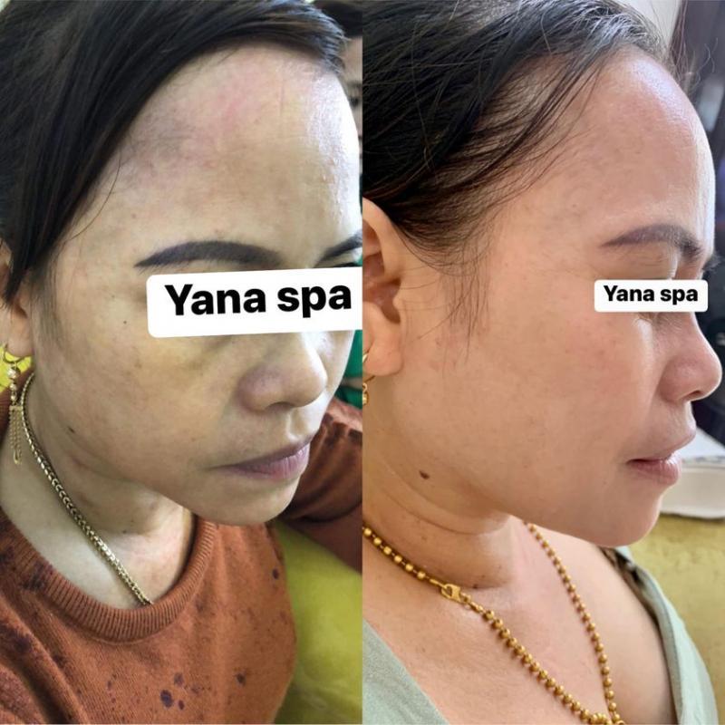 Top 9 Spa trị nám uy tín nhất tỉnh Thừa Thiên Huế