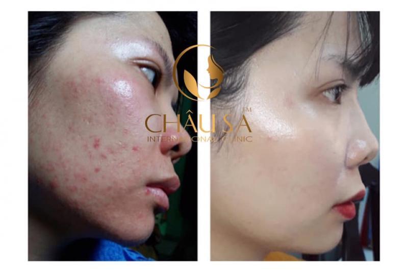 9 Spa trị mụn tốt nhất tại Quảng Ngãi