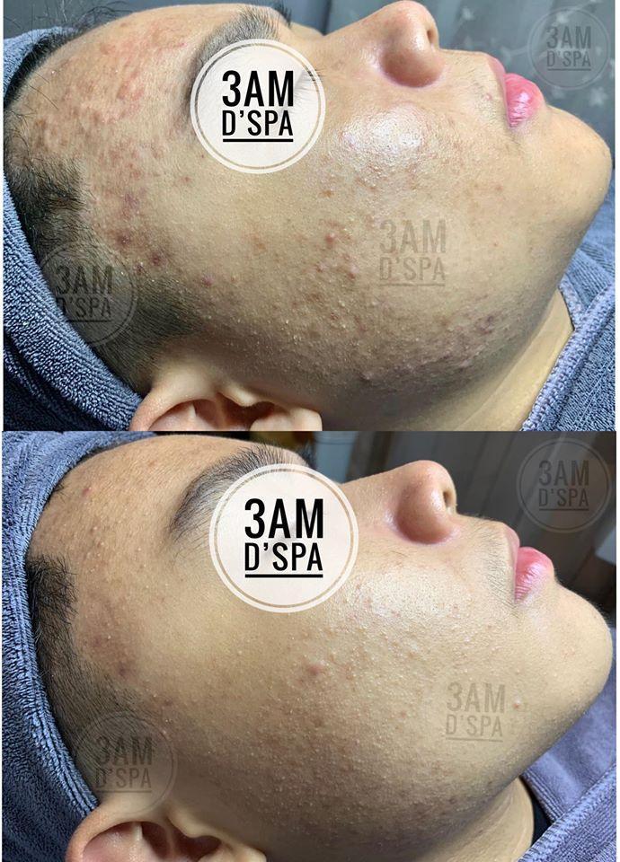 Top 8 địa chỉ chăm sóc da mụn uy tín chỉ từ 100.000 đồng tại Hà Nội