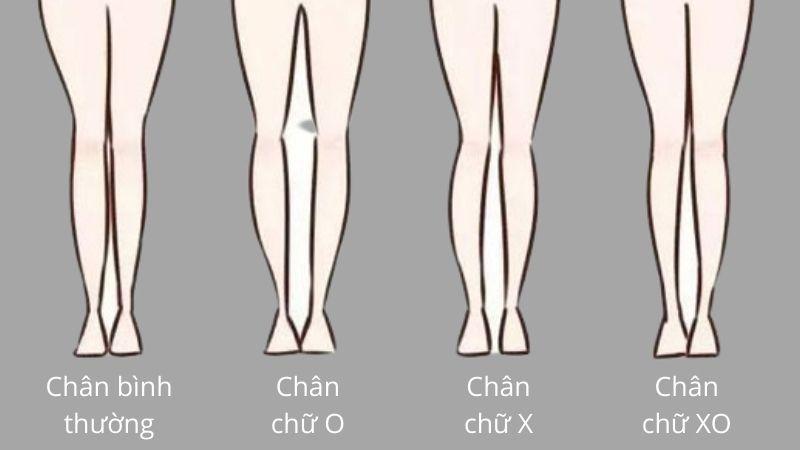 Khám phá 10 phương pháp đơn giản chữa chân vòng kiềng cho người lớn ngay tại nhà