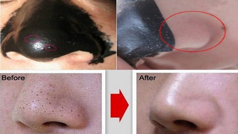 Bạn đã hiểu rõ cách loại bỏ mụn đầu đen hiệu quả mà không làm lỗ chân lông bị giãn nở chưa?