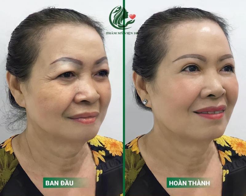 Top 4 địa chỉ nâng cung chân mày đẹp, uy tín hàng đầu tại Nghệ An