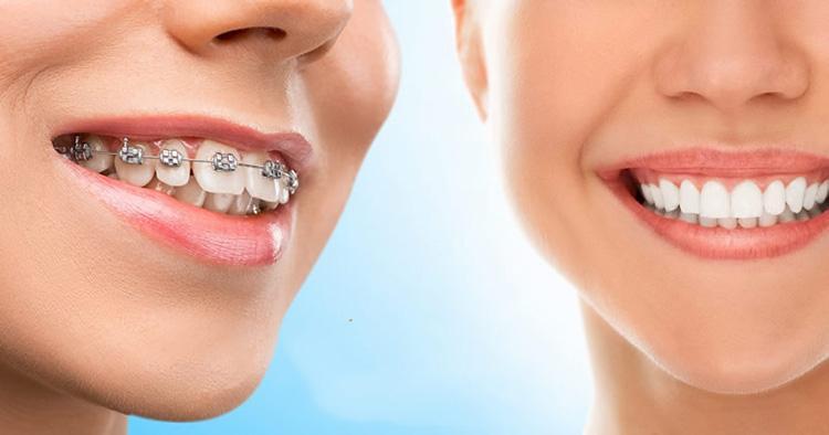 Khám Phá 6 Điều Quan Trọng Về Niềng Răng Mắc Cài Tự Buộc
