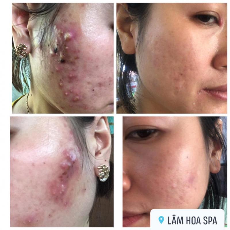 Top 4 spa trị mụn hiệu quả nhất tại TX. Quảng Yên, Quảng Ninh