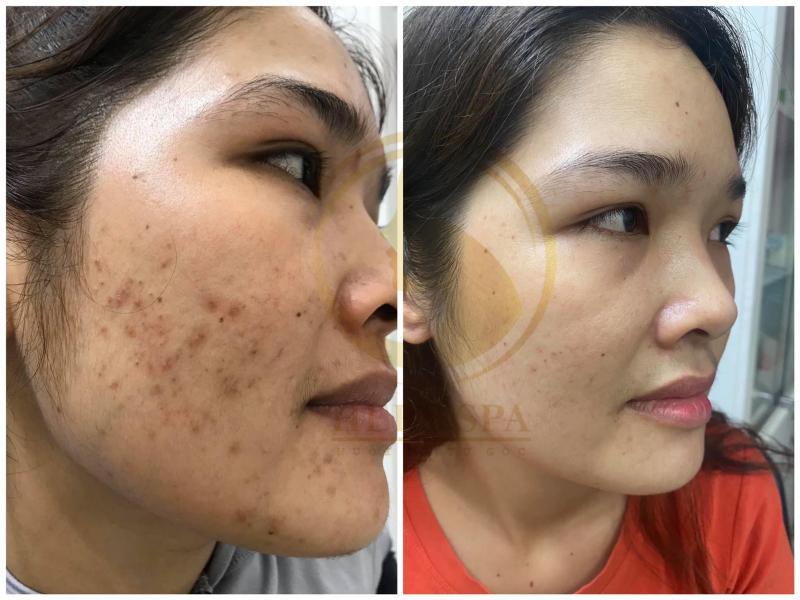 Top 11 Spa trị mụn hiệu quả tại TP. Nha Trang, Khánh Hòa